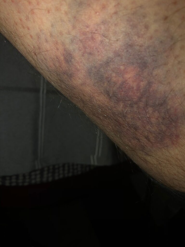 Bruise